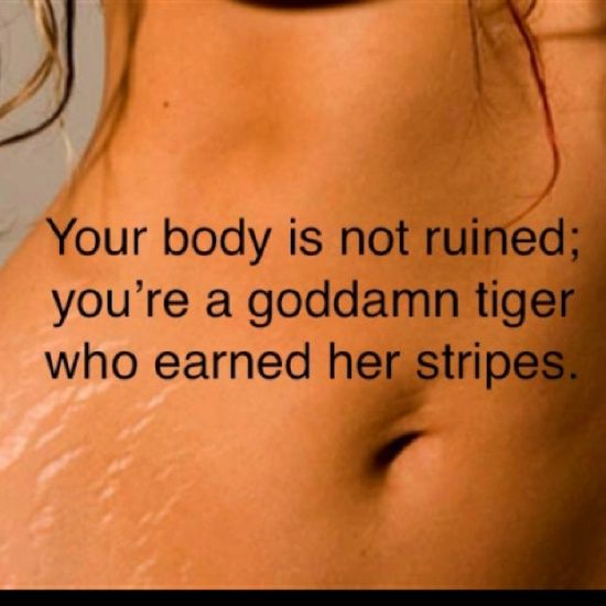 stretch marks photo