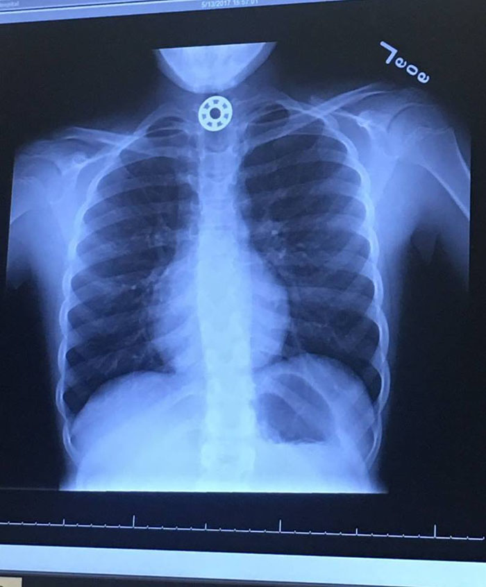 X Ray result showing the swallowed Fidget Spinners metal bearing
